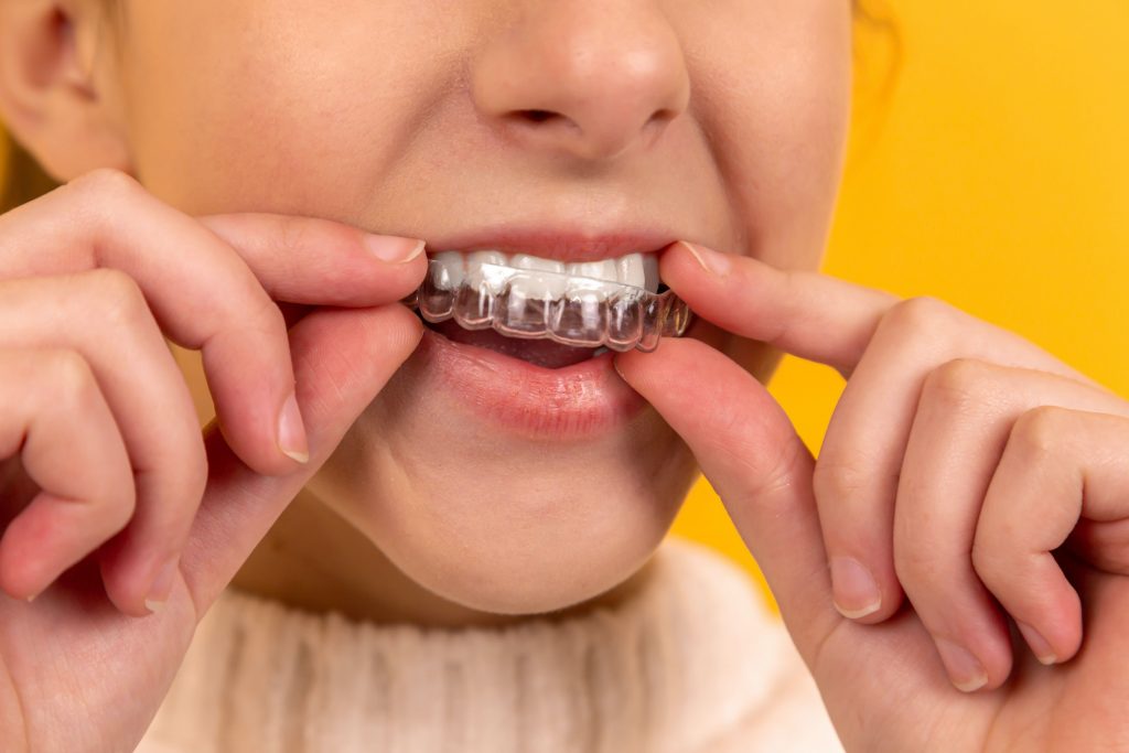 Can You Use Your Aligner as a Whitening Tray?