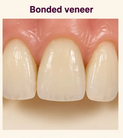 Veneer stage three: a natural-looking ceramic veneer bonded to the same front tooth