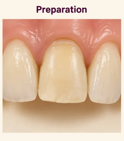 Veneer stage two: the same front tooth conservatively prepared for a veneer
